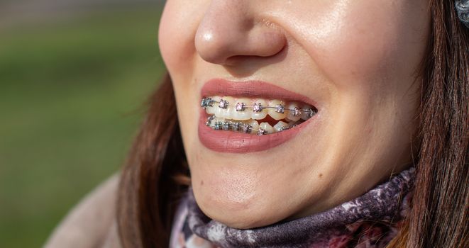 Brasket system in a girl's smiling mouth, macro photography of teeth, close-up of lips