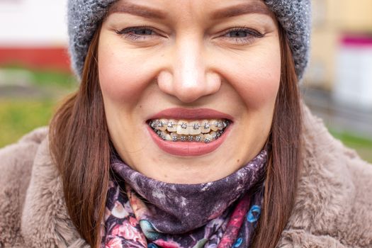 Brasket system in a girl's smiling mouth, macro photography of teeth. large face and painted lips