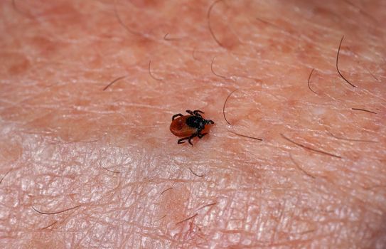 Small tick Ixodes ricinus crawling on human skin.