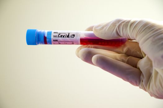 Covid - 19 and corona virus blood test sample, negative and positive tests, reagents and glassware.