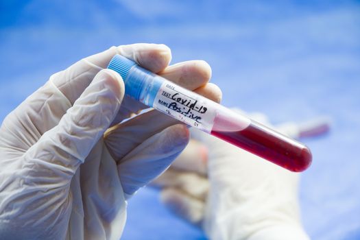 Corona virus positive blood test tubes on the white background, studio shoot. Blood test samples. Diagnosis and laboratory.