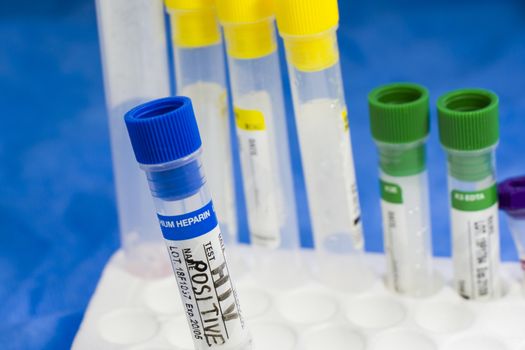 HIV and aids infection test, doctors face and hand holding tube with blood on the blue background. Studio shoot.