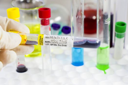 Hepatitis blood test tube samples