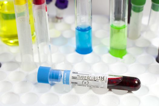 Tuberculosis blood test tube, laboratory and diagnoses