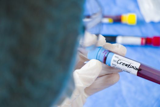 Creatinine blood test tube sample in doctors hand in laboratory, doctors face