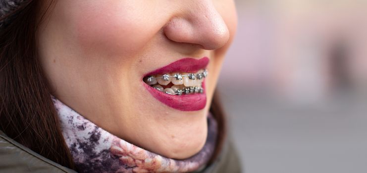 The brace system in the girl's smiling mouth, macro photography of teeth, close-up of red lips. Girl walking on the street