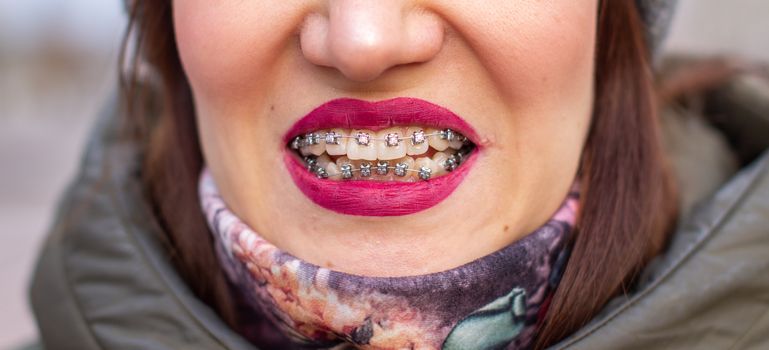 The brace system in the girl's smiling mouth, macro photography of teeth, close-up of red lips. Girl walking on the street