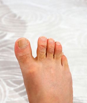 allergic skin rash on the toes, fungal disease of the toes,