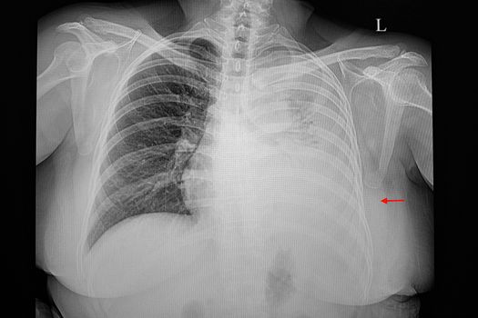 A chest xray film of a patient with massive pleural effusion. Fluid in the lungs. Medical education and diagnostic radiology concept.