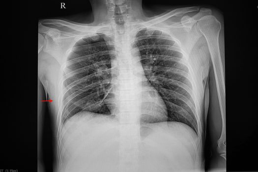 Chest x-ray showing small pneumothorax on the right side of lung. The pathology causes by a small bronchopleural fistula.
