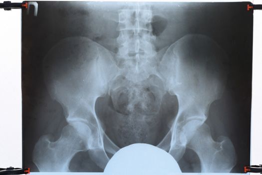 X-ray of the pelvis and sacrum. X-ray image.