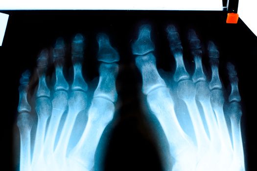 X-ray of toes. Foot on X-ray. bone research