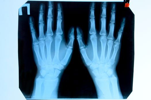 X-ray of the hands, a picture of the bones of the hands on the x-ray.