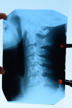 X-ray of the cervical vertebrae. X-ray image of the cervical spine.