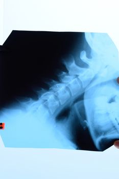 X-ray of the cervical vertebrae. X-ray image of the cervical spine.