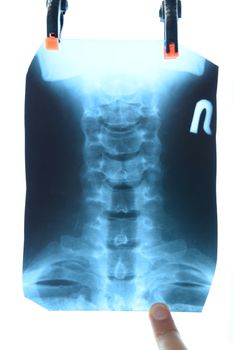 X-ray of the cervical vertebrae. X-ray image of the cervical spine.