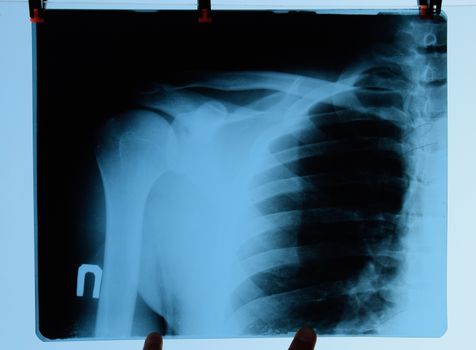 X-ray of shoulder and clavicle, X-ray picture of shoulder joint.