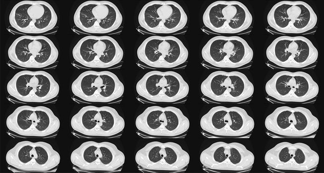 Computed tomography of the lungs in a healthy adult man. Normal lungs ct scan in horizontal or transverse plane. Sequaentional. May be part of COVID-19 diagnostic.