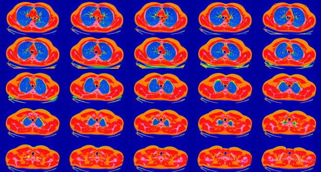 Computed tomography of the lungs in a healthy adult man. Normal lungs ct scan in horizontal or transverse plane, spectral toned. Sequaentional. May be part of COVID-19 diagnostic.