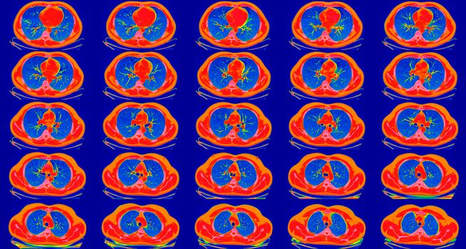 Computed tomography of the lungs in a healthy adult man. Normal lungs ct scan in horizontal or transverse plane, spectral toned. Sequaentional. May be part of COVID-19 diagnostic.