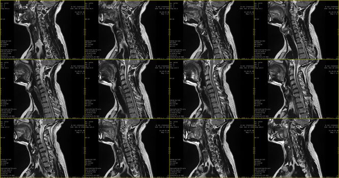 set of sagittal MRI scans of neck area of 34 years old caucasian male with herniaset of MRI scans of neck area of caucasian male with bilateral paramedial, with a left accent, extrusion of the C6-C7 segment with left-sided C7 radiculopathy, moderate paresis of the triceps of the left hand.