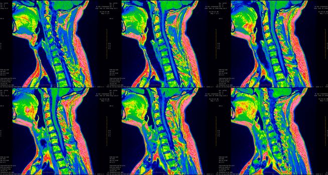 set of 6 green colored sagittal MRI scans of neck area of 34 years old caucasian male with herniaset of MRI scans of neck area of caucasian male with bilateral paramedial, with a left accent, extrusion of the C6-C7 segment with left-sided C7 radiculopathy, moderate paresis of the triceps of the left hand.