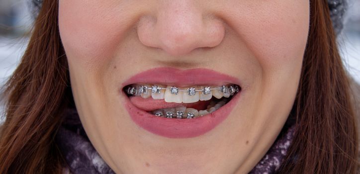 Braces in a girl's smiling mouth, macro photography of teeth, close-up of red lips. Tongue between the lips. A girl walks down the street