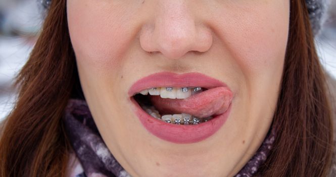 Braces in a girl's smiling mouth, macro photography of teeth, close-up of red lips. Tongue between the lips. A girl walks down the street