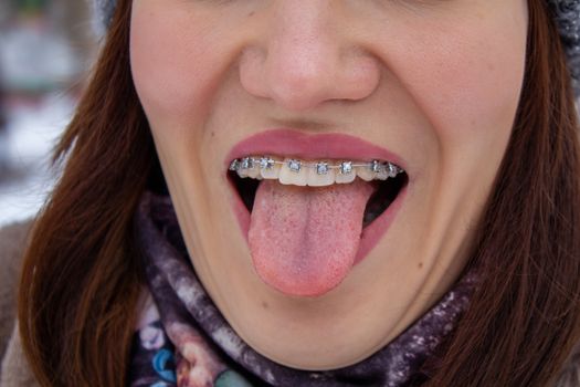 Braces in a girl's smiling mouth, macro photography of teeth, close-up of red lips. Tongue between the lips. A girl walks down the street
