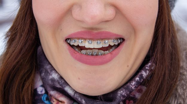 Brasket system in a girl's smiling mouth, macro photography of teeth. large face and painted lips. Braces on the girl's teeth