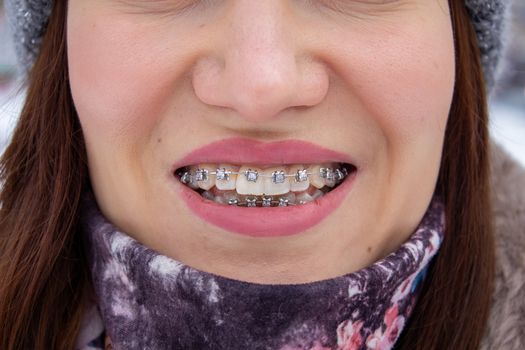 Brasket system in a girl's smiling mouth, macro photography of teeth. large face and painted lips. Braces on the girl's teeth