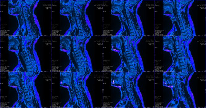 set of 12 blue sagittal MRI scans of neck area of 34 years old caucasian male with herniaset of MRI scans of neck area of caucasian male with bilateral paramedial, with a left accent, extrusion of the C6-C7 segment with left-sided C7 radiculopathy, moderate paresis of the triceps of the left hand.