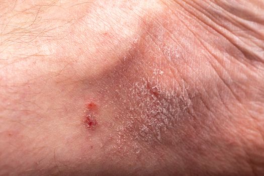 Close up dermatitis on the foot skin. Ill allergic peeling skin of patient.