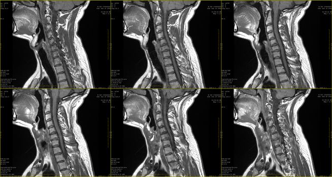set of 6 sagittal MRI scans of neck area of 34 years old caucasian male with herniaset of MRI scans of neck area of caucasian male with bilateral paramedial, with a left accent, extrusion of the C6-C7 segment with left-sided C7 radiculopathy, moderate paresis of the triceps of the left hand.