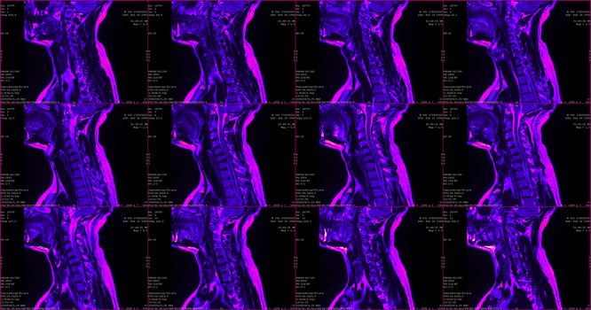 set of 6 green colored sagittal MRI scans of neck area of 34 years old caucasian male with herniaset of MRI scans of neck area of caucasian male with bilateral paramedial, with a left accent, extrusion of the C6-C7 segment with left-sided C7 radiculopathy, moderate paresis of the triceps of the left hand.