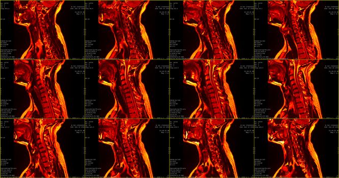 set of 12 red colored sagittal MRI scans of neck area of 34 years old caucasian male with herniaset of MRI scans of neck area of caucasian male with bilateral paramedial, with a left accent, extrusion of the C6-C7 segment with left-sided C7 radiculopathy, moderate paresis of the triceps of the left hand.