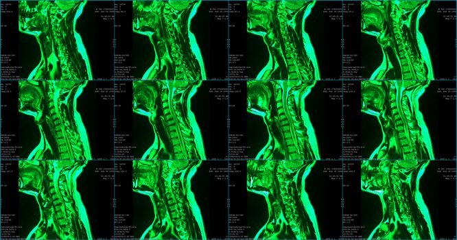 set of 6 green colored sagittal MRI scans of neck area of 34 years old caucasian male with herniaset of MRI scans of neck area of caucasian male with bilateral paramedial, with a left accent, extrusion of the C6-C7 segment with left-sided C7 radiculopathy, moderate paresis of the triceps of the left hand.