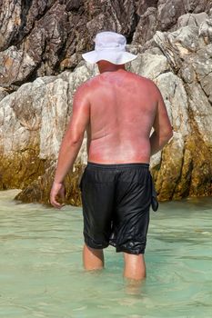 Burning man smeared with sunscreen. A man sunburned in the sun with red skin in a white panama hat and black shorts is knee-deep in water against the backdrop of rocks.