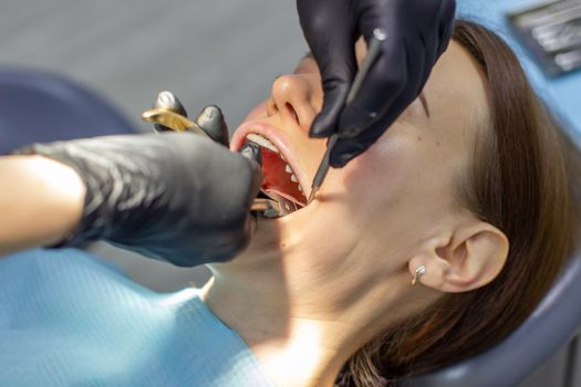 Beautiful woman in dental chair during procedure of installing braces to upper and lower teeth. Dentist and assistant working together, dental tools in their hands. Top view. Concept of dentistry