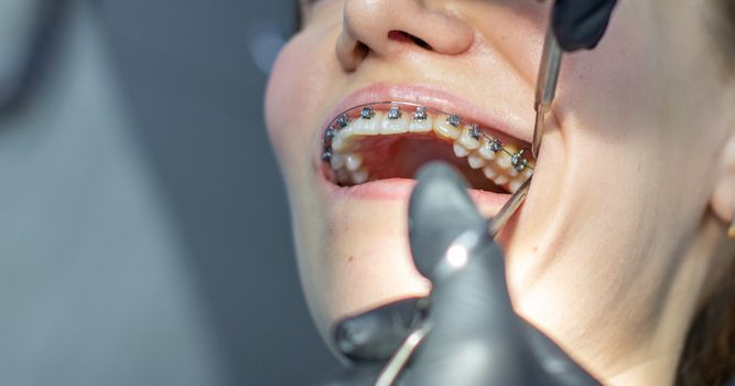 A woman with dental braces visits an orthodontist in the clinic, in a dental chair. during the procedure of installing the arch of braces on the upper and lower teeth. The dentist is wearing gloves and has dental instruments in his hands. The concept of dentistry