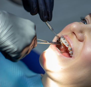 A woman with dental braces visits an orthodontist in the clinic, in a dental chair. during the procedure of installing the arch of braces on the upper and lower teeth. The dentist is wearing gloves and has dental instruments in his hands. The concept of dentistry