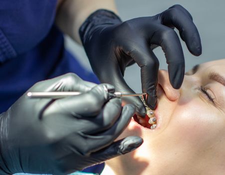 A woman with dental braces visits an orthodontist in the clinic, in a dental chair. during the procedure of installing the arch of braces on the upper and lower teeth. The dentist is wearing gloves and has dental instruments in his hands. The concept of dentistry