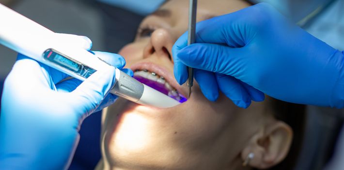 A woman with dental braces visits an orthodontist at the clinic. in the dental chair during the procedure of installing braces on the upper and lower teeth. Dentist and assistant work together, they have dental instruments in their hands. concept of dentistry