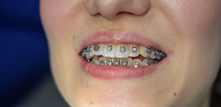 A woman with braces on her teeth visits an orthodontist, in a dental chair. during the procedure of installing the arch of braces on the upper and lower teeth. The girl smiles.The concept of dentistry