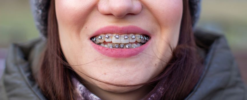 Brasket system in a girl's smiling mouth, macro photography of teeth. large face and painted lips. Braces on the girl's teeth