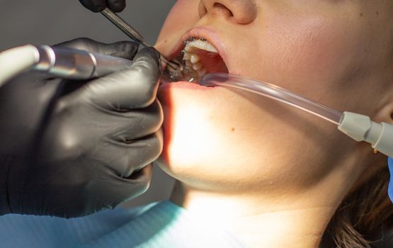 A woman with dental braces visits an orthodontist at the clinic. in the dental chair during the procedure of installing braces on the upper and lower teeth. Dentist and assistant work together, they have dental instruments in their hands. concept of dentistry