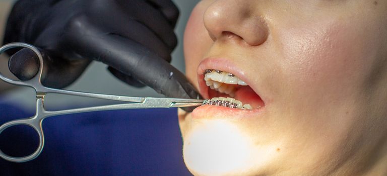 A woman with braces visits an orthodontist, in a dental chair. during the procedure of installing the arch of braces on the lower teeth. The dentist is wearing gloves and holding a pair of forceps. 