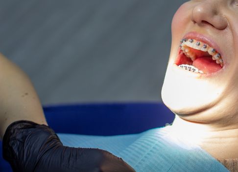 A woman with braces on her teeth visits an orthodontist in a dental chair. during the procedure of installing the arch of braces on the upper and lower teeth. The doctor examines the teeth. dentistry