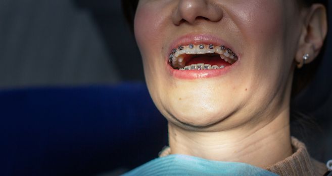 A woman with braces on her teeth visits an orthodontist, in a dental chair. during the procedure of installing the arch of braces on the upper and lower teeth. The girl smiles.The concept of dentistry