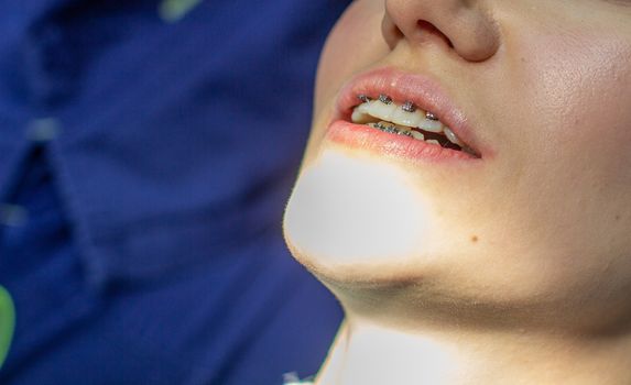 A woman with braces on her teeth visits an orthodontist, in a dental chair. during the procedure of installing the arch of braces on the upper and lower teeth. The girl smiles.The concept of dentistry